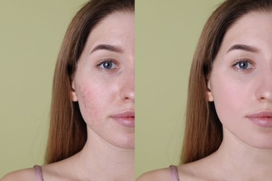 Image of Acne problem. Young woman before and after treatment on green background, collage of photos