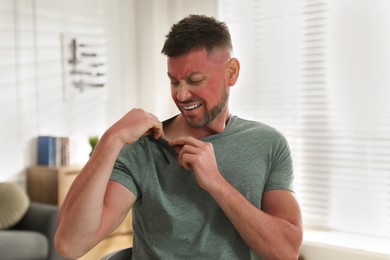 Man with sunburn on skin at home