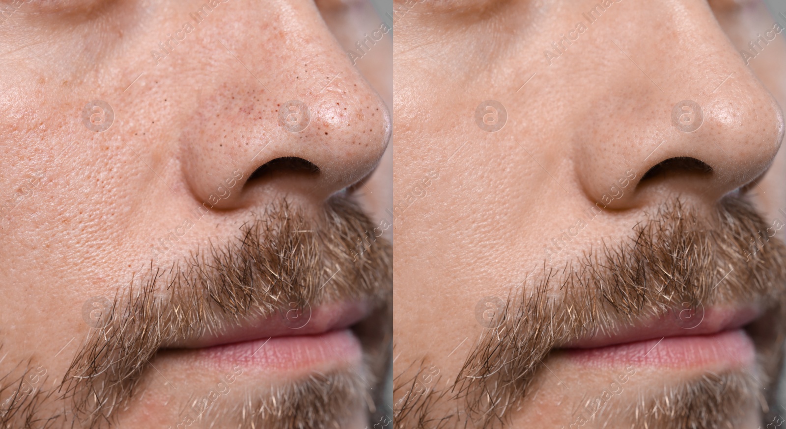 Image of Blackhead treatment, before and after. Collage with photos of man, closeup view