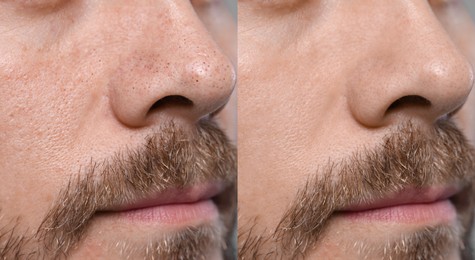 Blackhead treatment, before and after. Collage with photos of man, closeup view