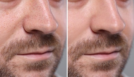 Image of Blackhead treatment, before and after. Collage with photos of man on grey background, closeup view