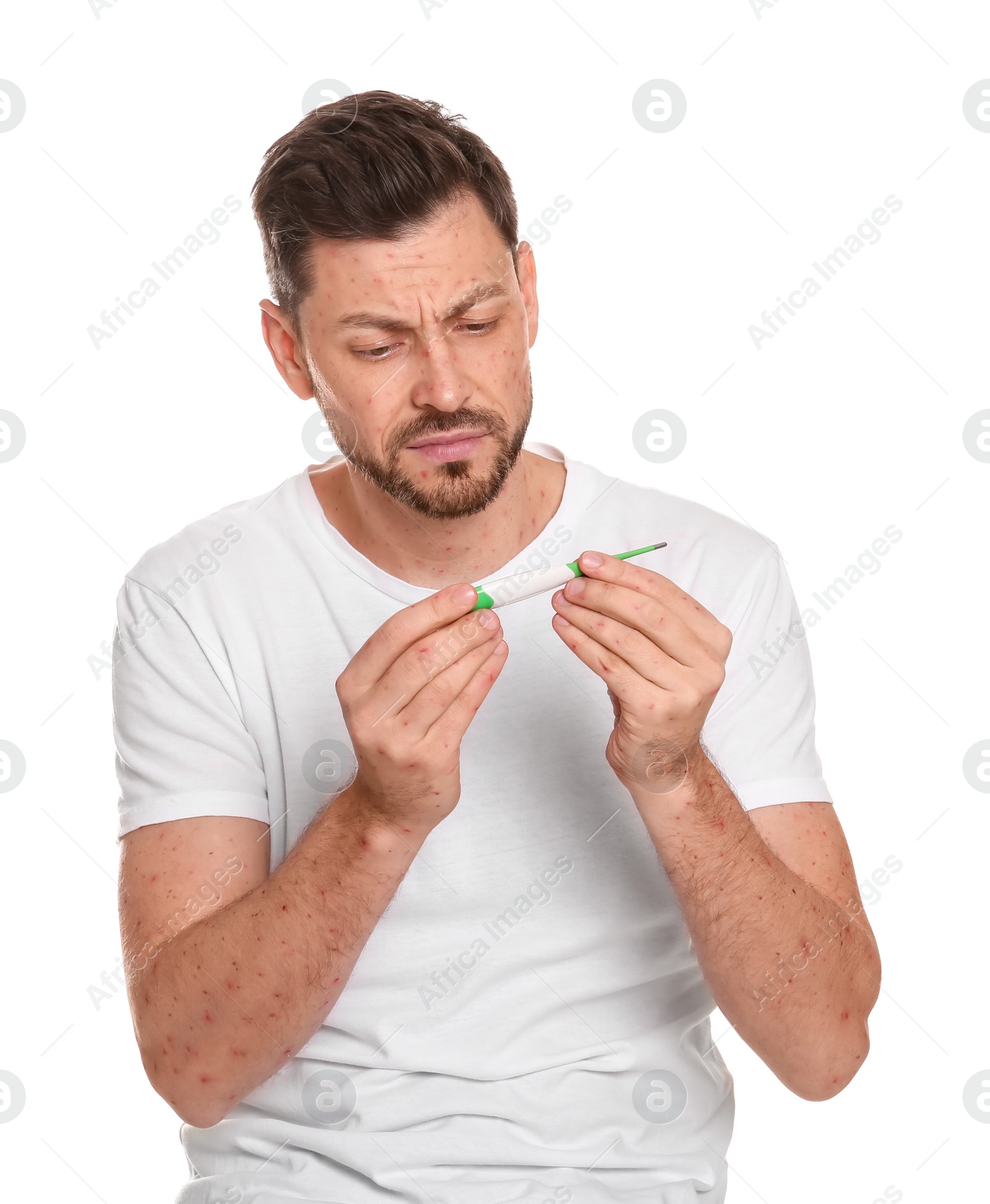 Photo of Man with rash holding thermometer on white background. Monkeypox virus diagnosis