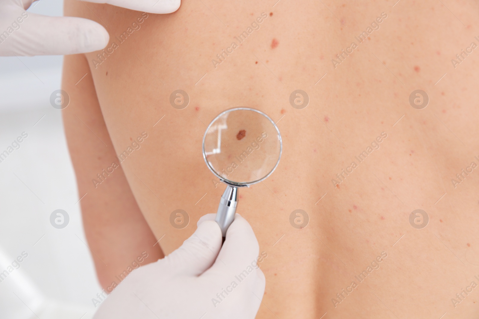 Photo of Dermatologist examining patient's birthmark with magnifying glass in clinic, closeup