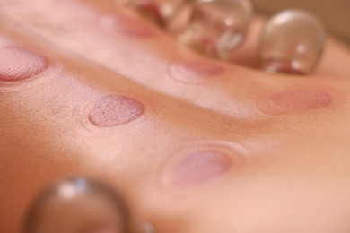 Cupping therapy. Closeup view of man with glass cups on his back indoors