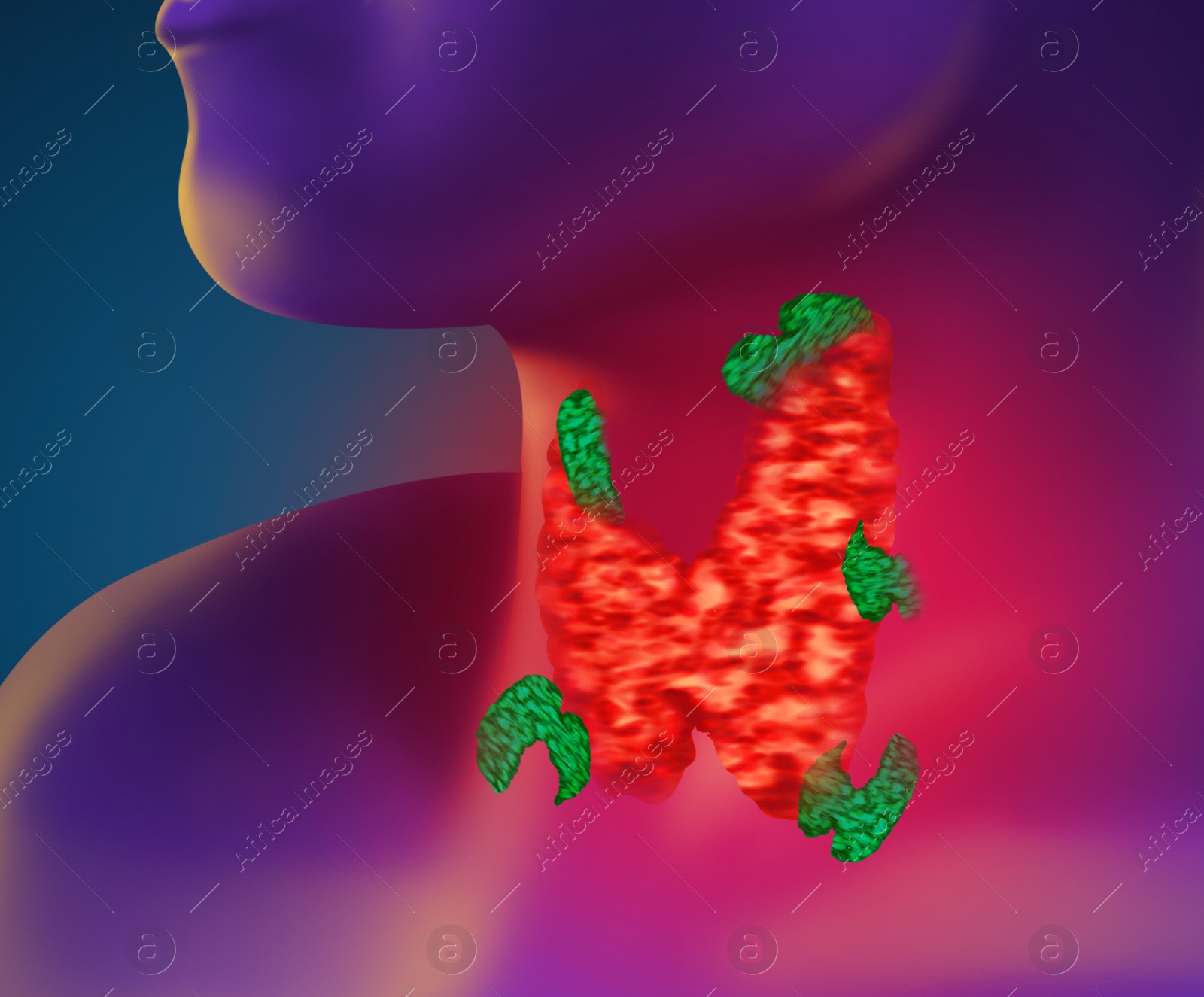 Illustration of  human with inflamed thyroid gland on color background