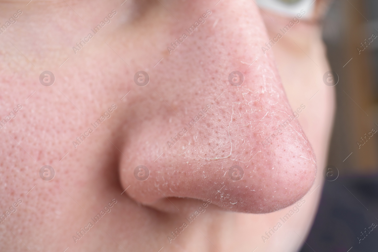 Photo of Woman with dry skin on nose, closeup