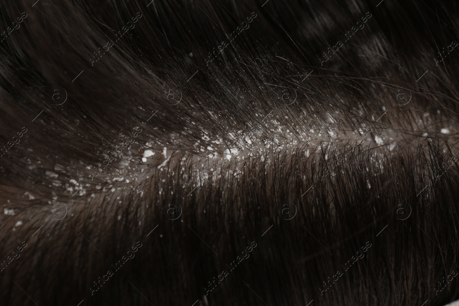 Photo of Man with dandruff in his dark hair, macro view