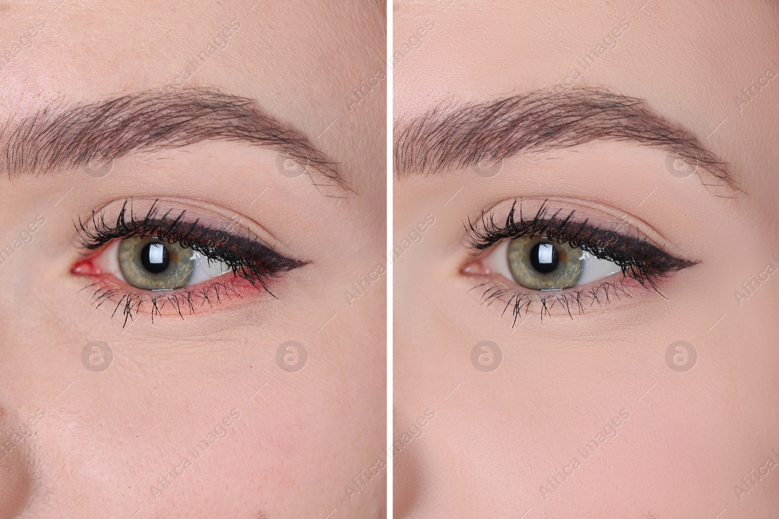 Image of Collage with photos of woman before and after conjunctivitis treatment, closeup of eye