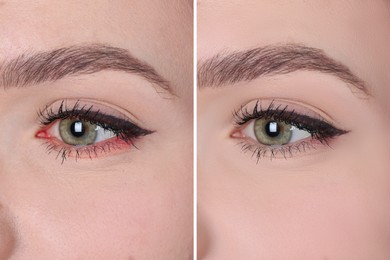 Collage with photos of woman before and after conjunctivitis treatment, closeup of eye