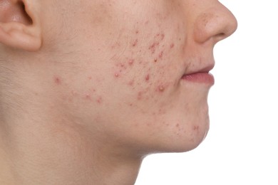 Young man with acne problem isolated on white, closeup