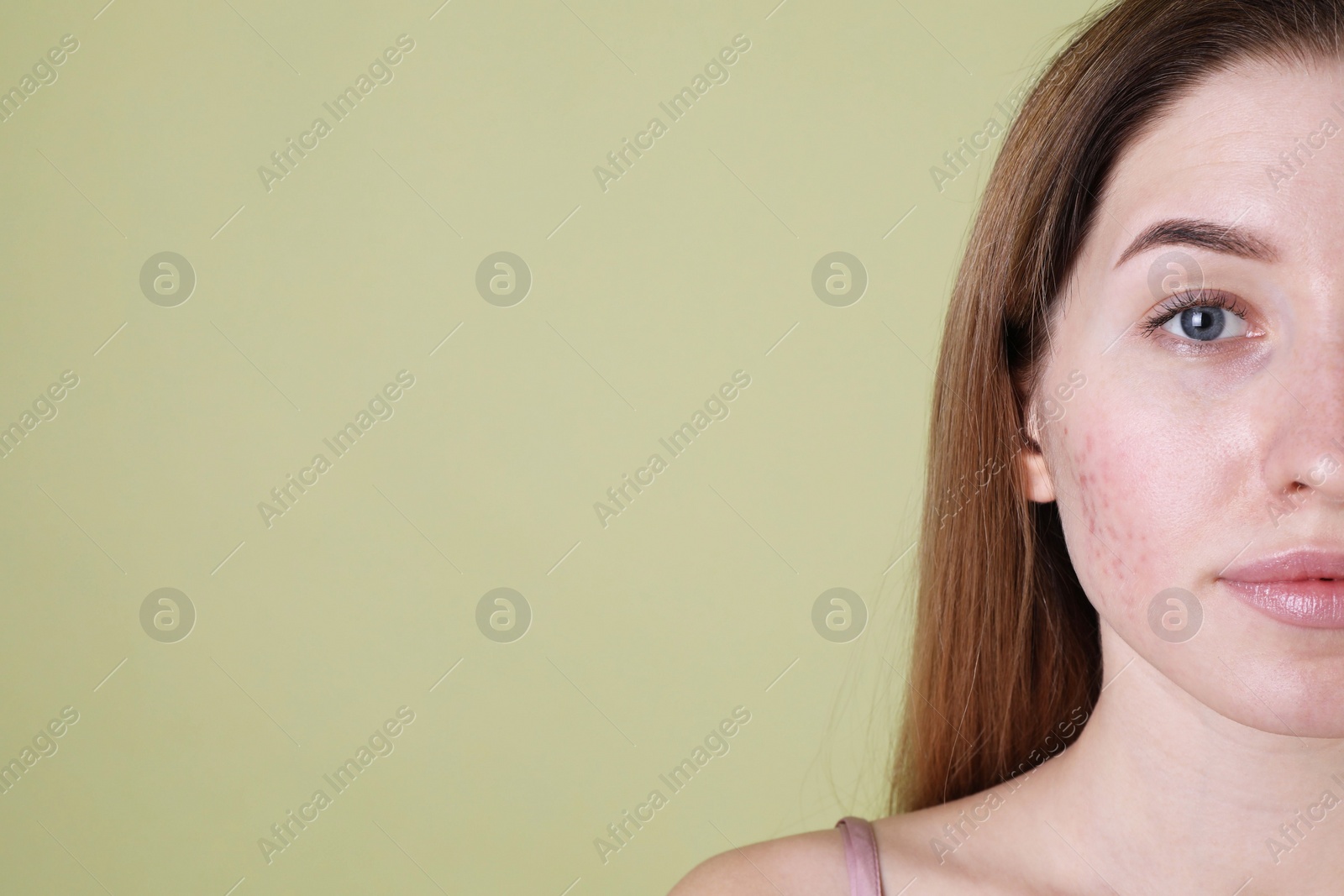 Photo of Young woman with acne problem on olive background, closeup. Space for text