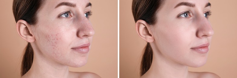 Image of Acne problem. Young woman before and after treatment on beige background, collage of photos