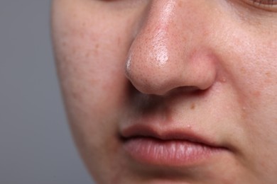 Closeup view of woman with comedones on her nose against grey background