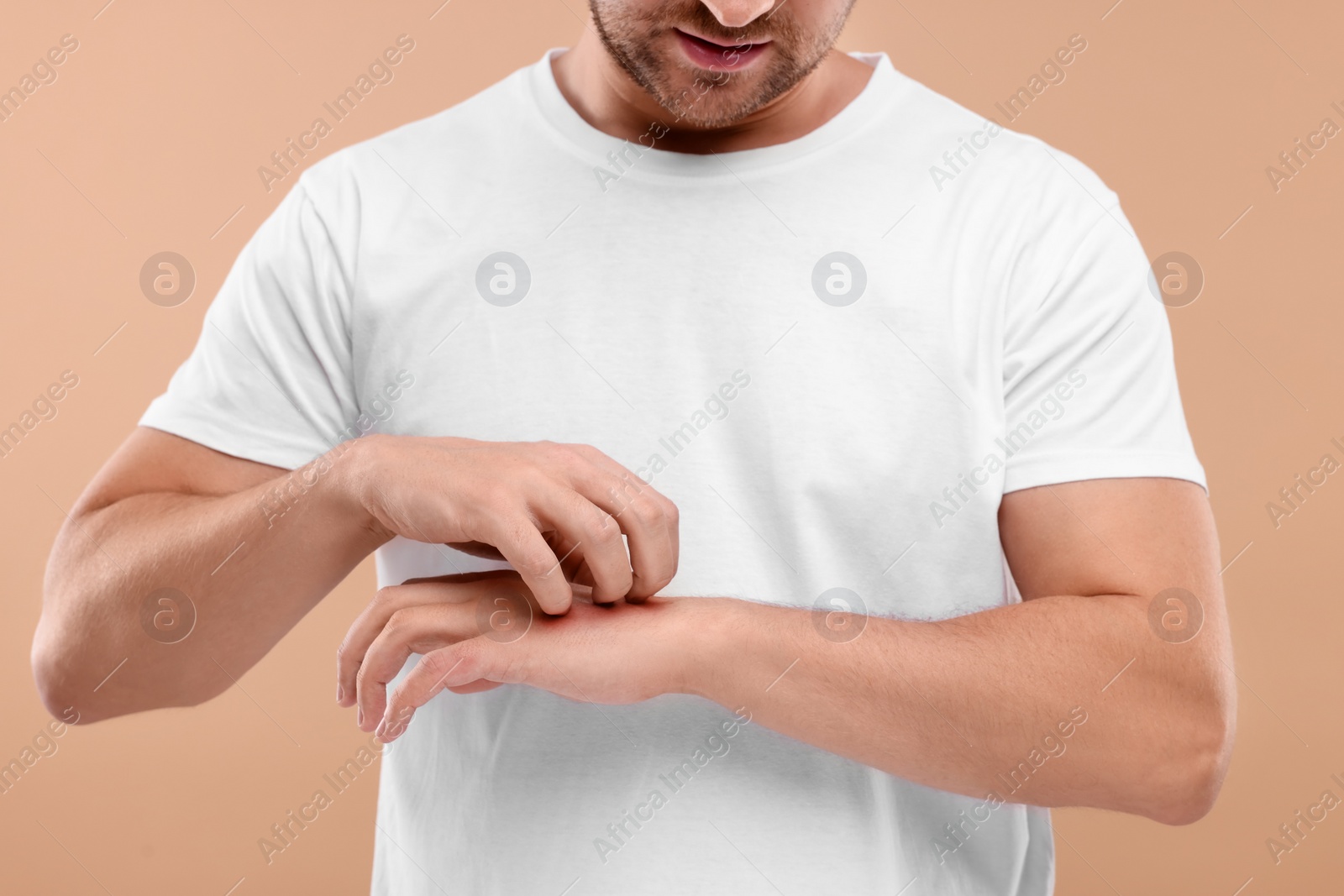 Photo of Allergy symptom. Man scratching his hand on light brown background, closeup