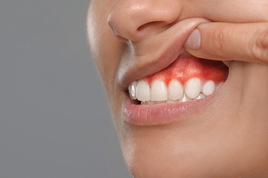 Woman showing inflamed gum on grey background, closeup. Space for text