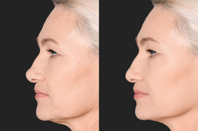 Image of Mature woman before and after cosmetic procedure on black background 