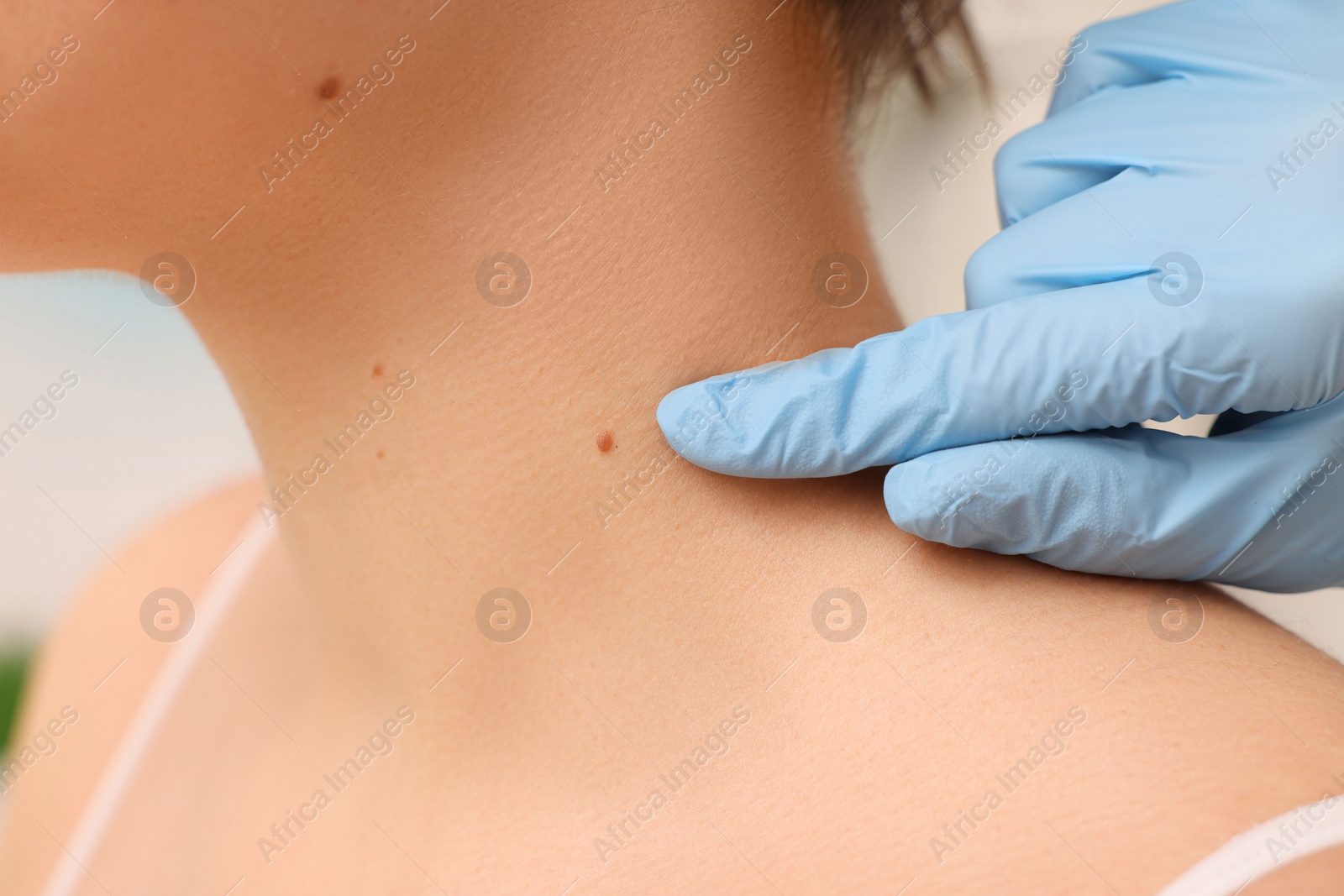 Photo of Dermatologist in rubber glove examining patient's birthmark, closeup view