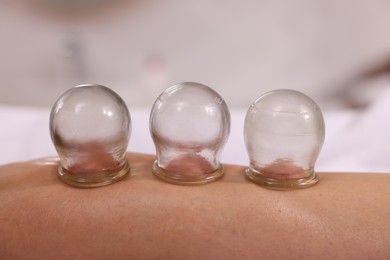 Cupping therapy. Closeup view of woman with glass cups on her leg indoors