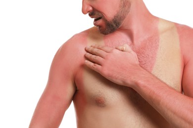 Man with sunburned skin on white background, closeup