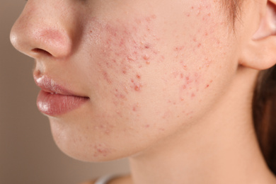 Photo of Teenage girl with acne problem on beige background, closeup