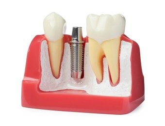 Photo of Educational model with post and abutment of dental implant between teeth on white background