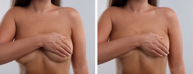 Collage with photos of woman before and after breast-lift surgery on light grey background, closeup