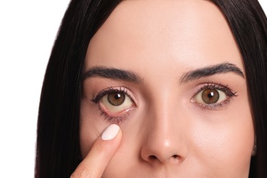 Photo of Woman checking her health condition on white background, closeup. Yellow eyes as symptom of problems with liver