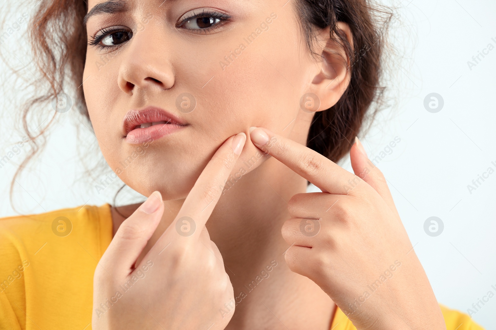 Photo of Beautiful young woman with acne problem on light background