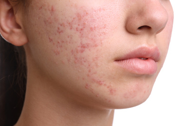 Photo of Teenage girl with acne problem on white background, closeup