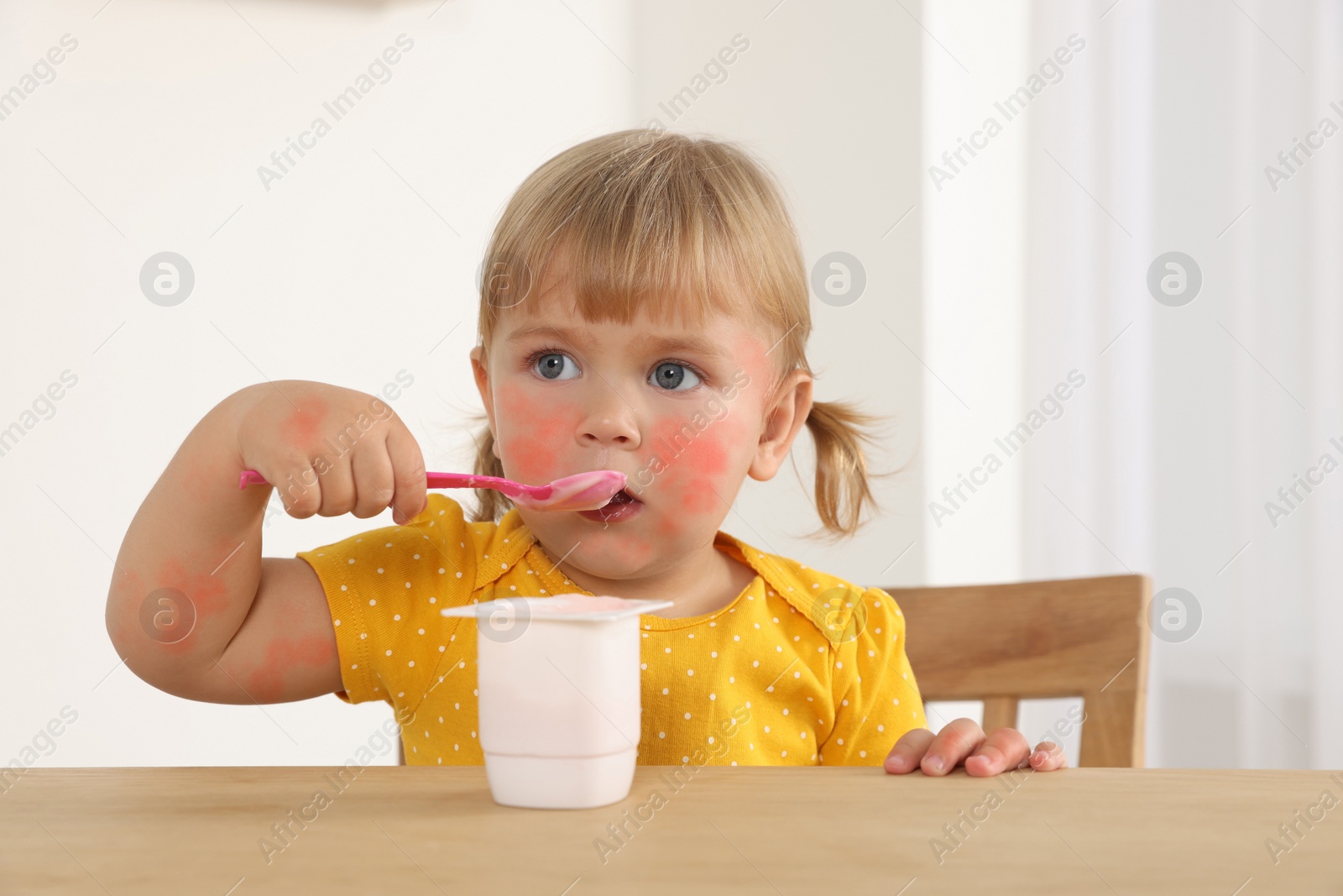 Image of Cute little child with allergic redness eating tasty yogurt at wooden table indoors