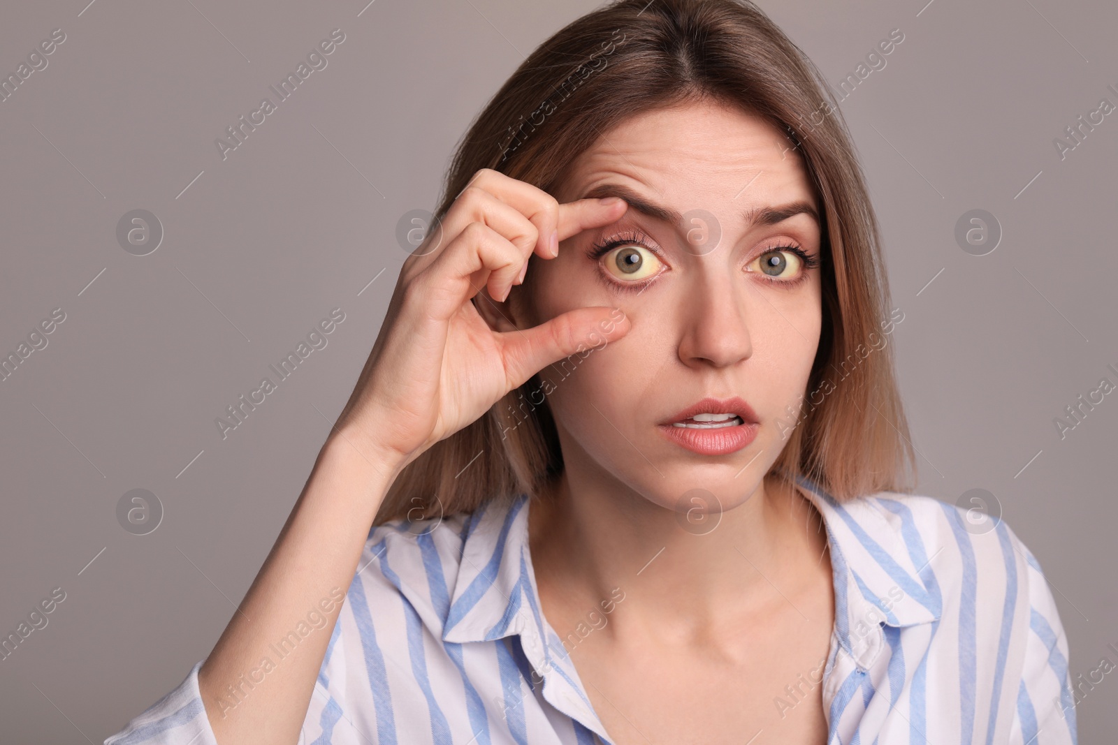 Photo of Woman checking her health condition on grey background. Yellow eyes as symptom of problems with liver