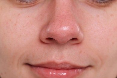 Photo of Closeup view of woman with blackheads on her nose