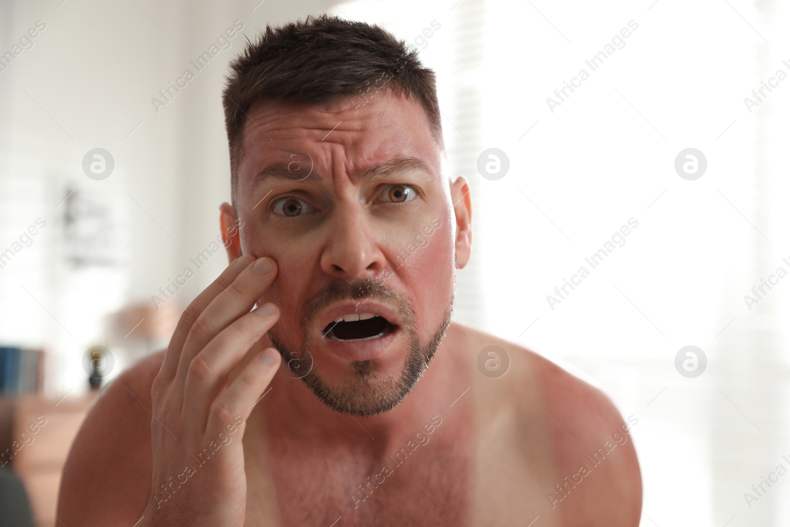 Photo of Man with sunburn on skin at home