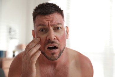 Photo of Man with sunburn on skin at home