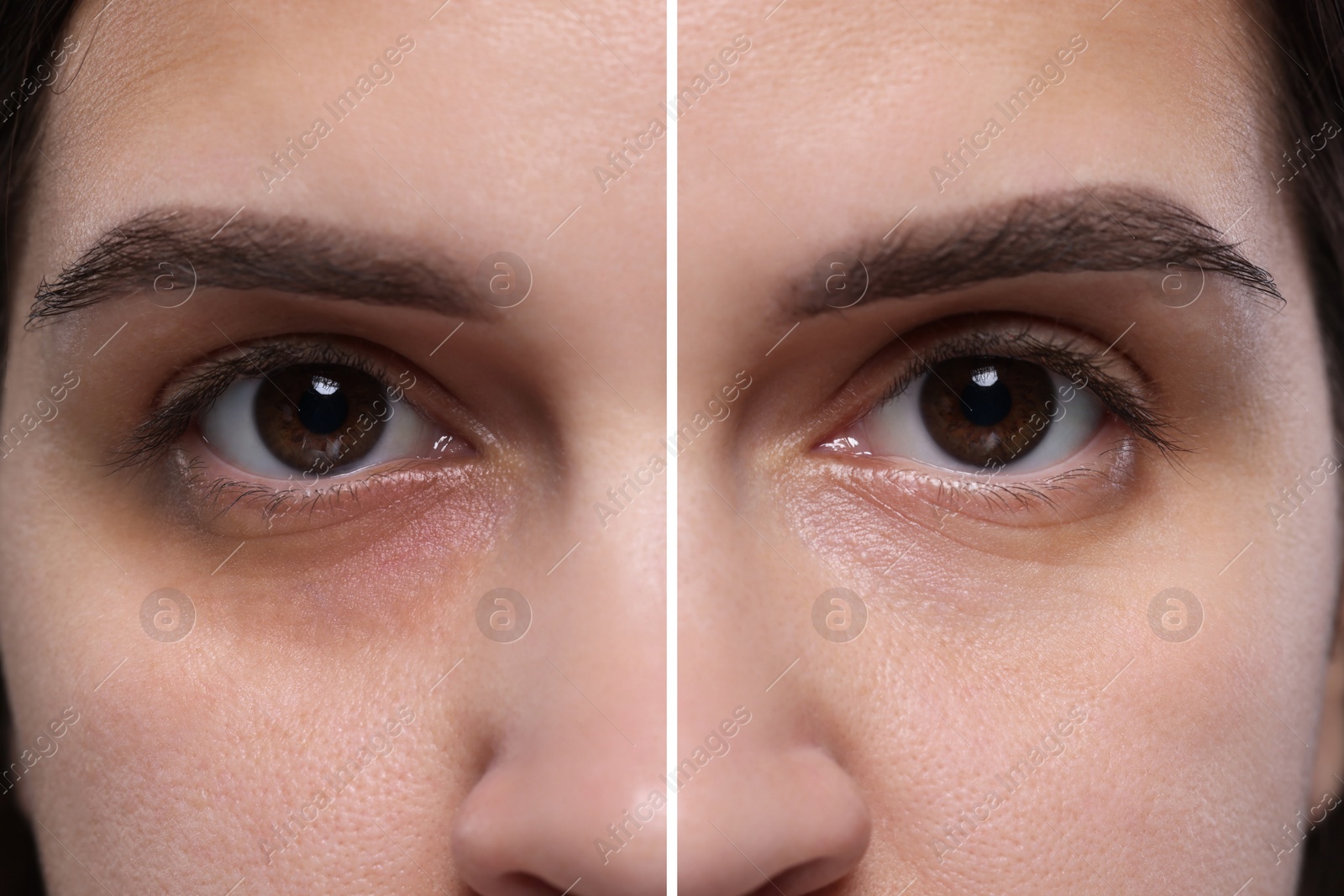 Image of Collage with photos of woman with dark circle under eye before and after treatment, closeup