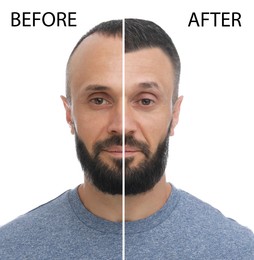 Man before and after hair loss treatment on white background, collage