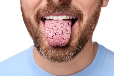Image of Dry mouth symptom. Man showing dehydrated tongue on white background, closeup