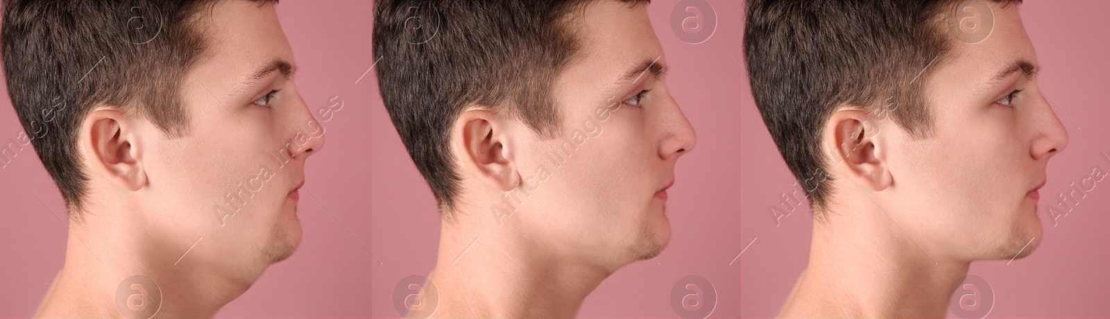 Image of Double chin problem. Collage with photos of man before and after plastic surgery procedure on pink background, banner design