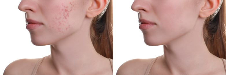 Acne problem. Young woman before and after treatment on white background, closeup. Collage of photos