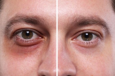 Image of Collage with photos of man with dark circle under eye before and after treatment, closeup