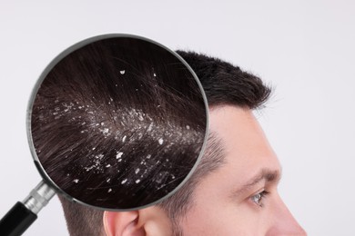 Man suffering from dandruff on white background, closeup. View through magnifying glass on hair with flakes