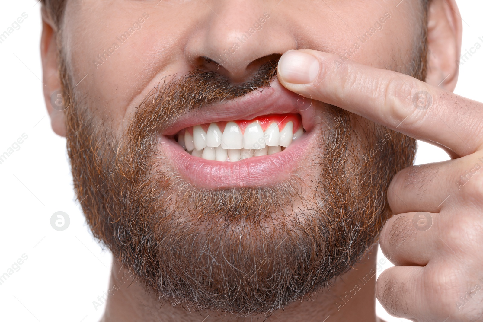 Image of Man showing inflamed gum on white background, closeup