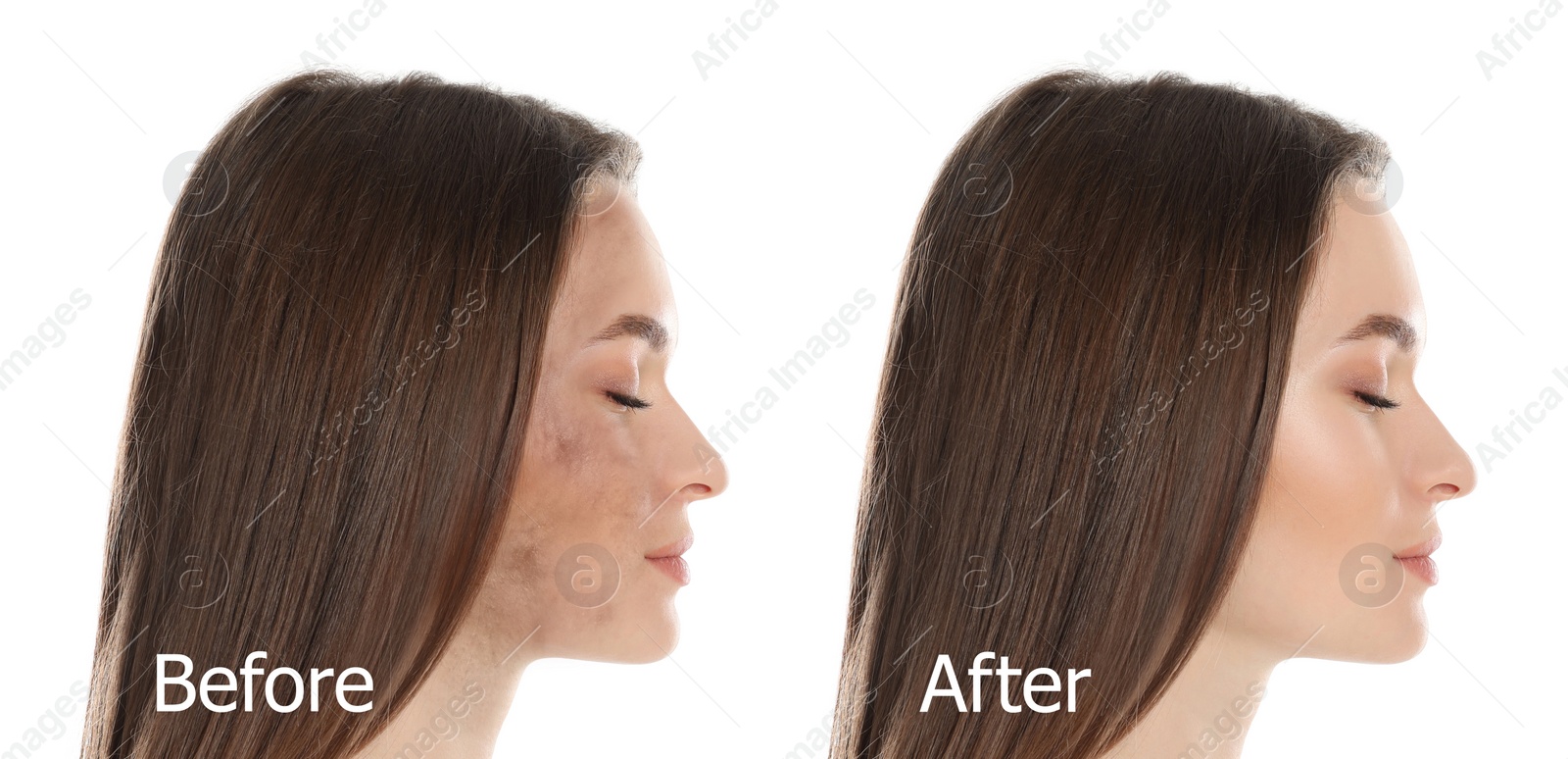 Image of Young woman before and after cosmetic procedure on white background