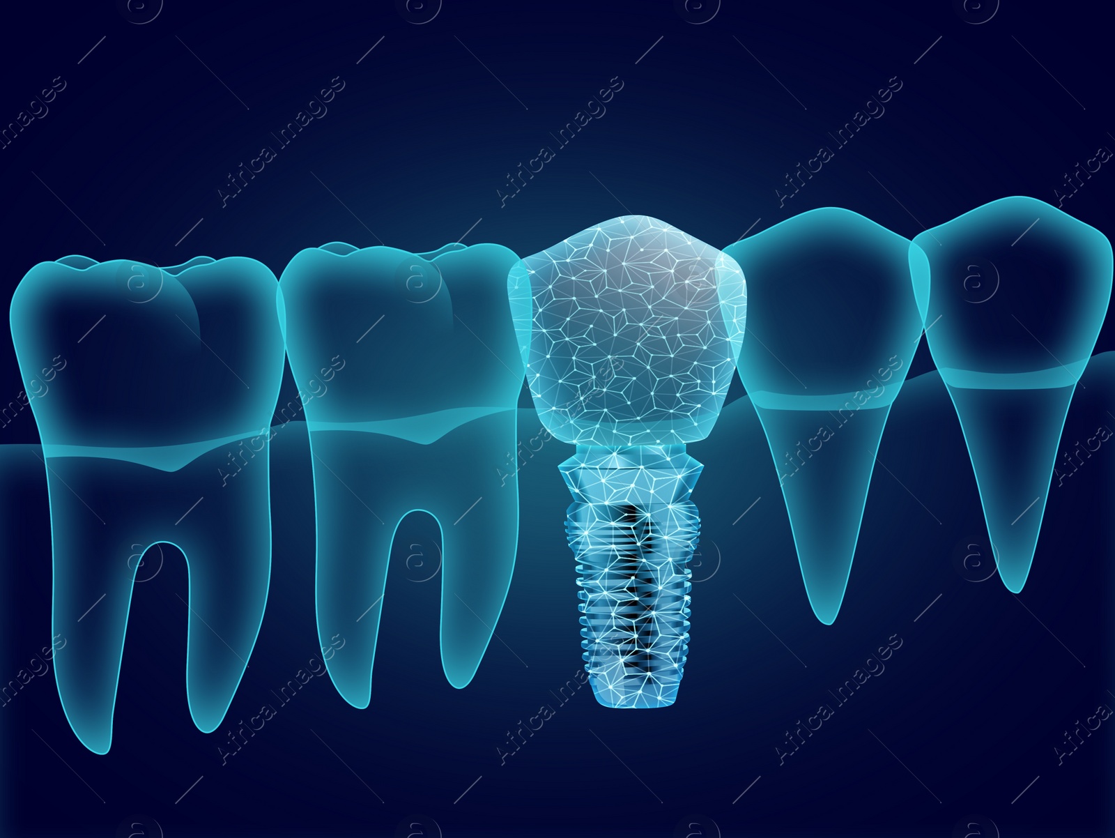 Illustration of  teeth and dental implant on dark blue background