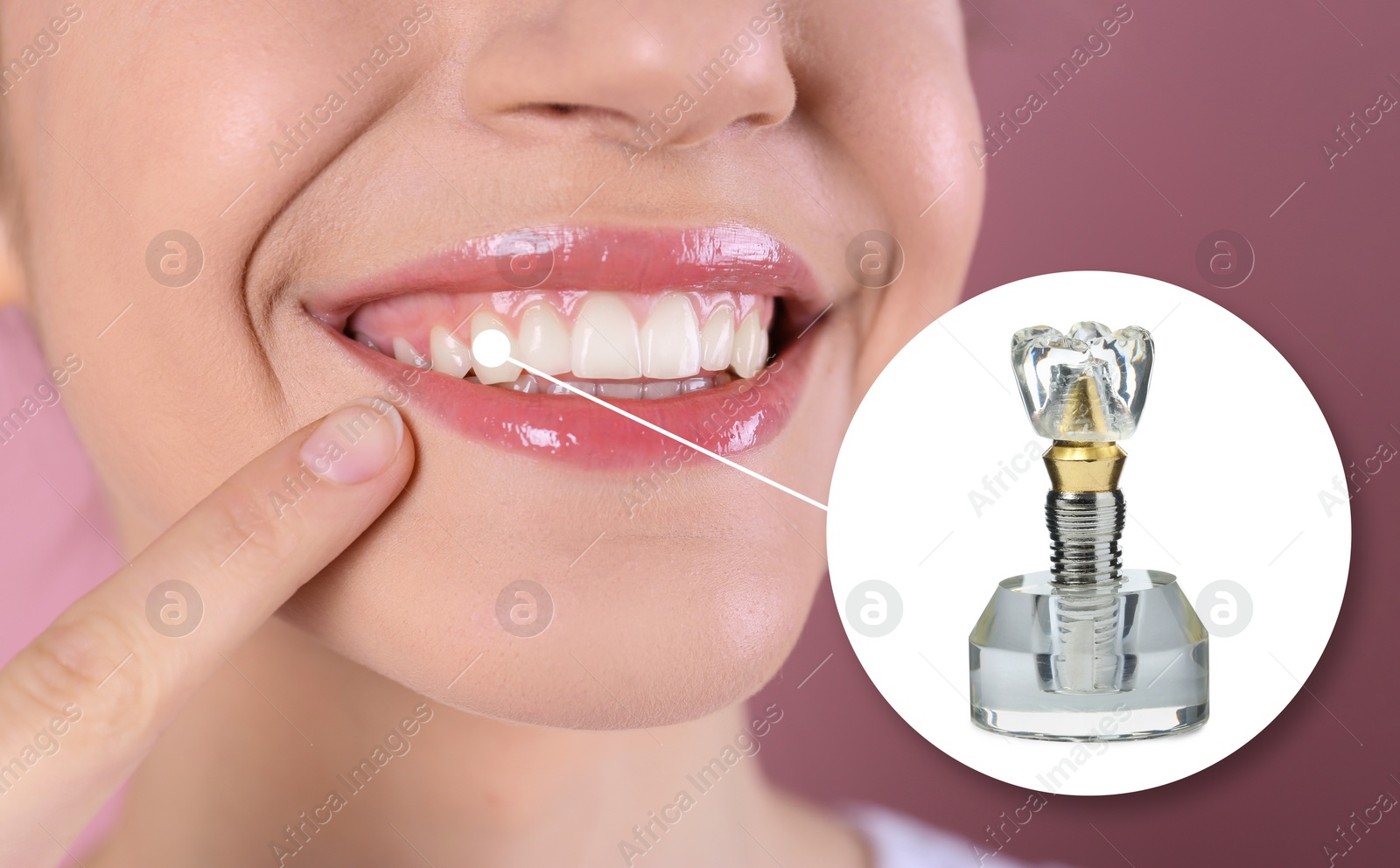 Image of Woman with beautiful smile after dental implant installation procedure on pink background, closeup