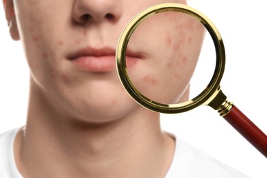 Dermatology. Man with skin problem on white background, closeup. View through magnifying glass on acne