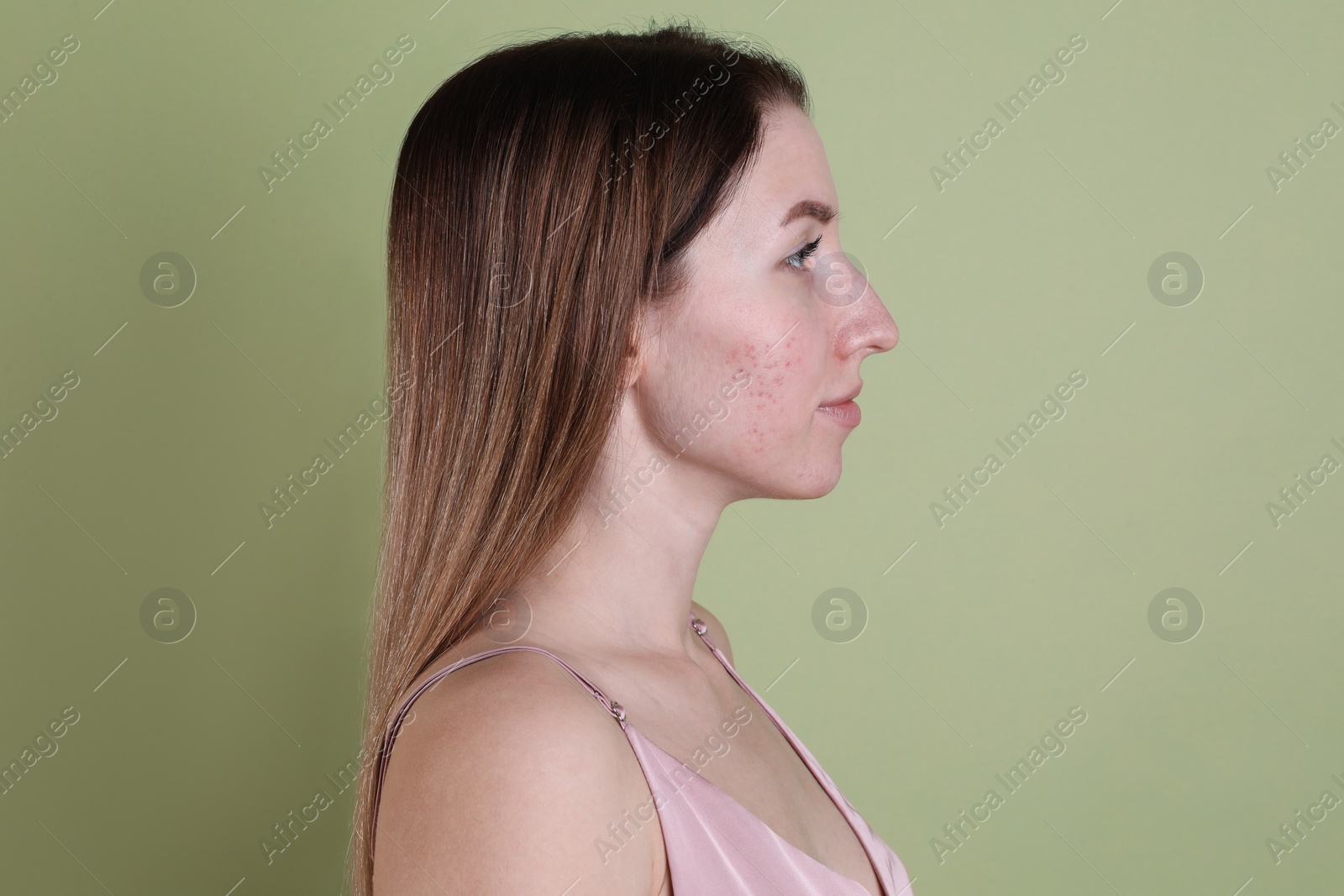 Photo of Young woman with acne problem on olive background