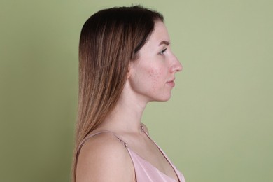 Photo of Young woman with acne problem on olive background