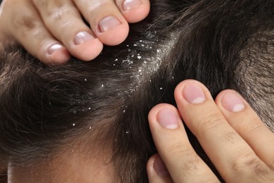 Man with dandruff in his dark hair, macro view