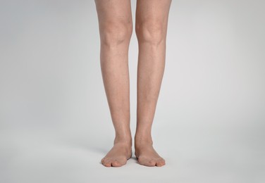 Photo of Closeup view of woman with varicose veins on light background